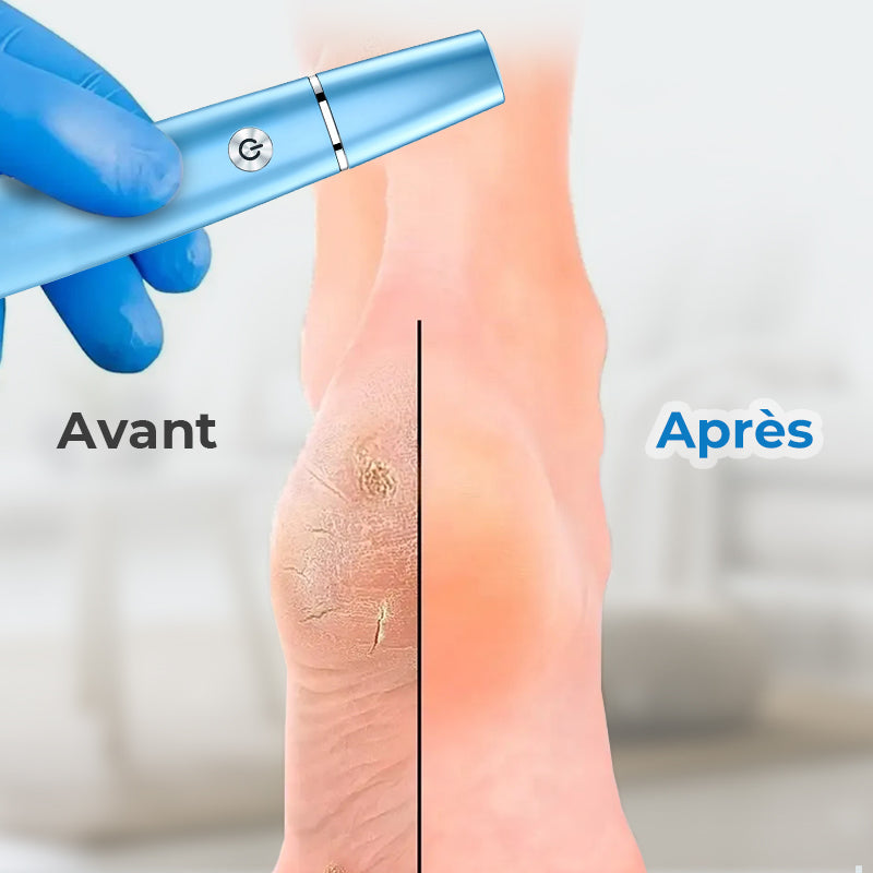 🔥VENTE LIMITÉE 50 % DE RÉDUCTION🔥Extracteur de callosités électrique pour les pieds