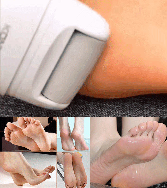 💥Offre à durée limitée💥Extracteur électrique rechargeable de callosités plantaires